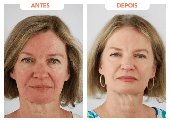 Regenere Drops antes e depois.