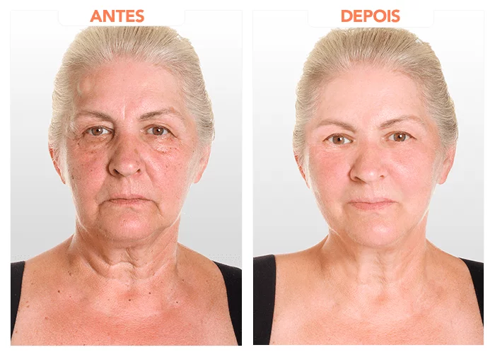 Regenere Drops antes e depois.