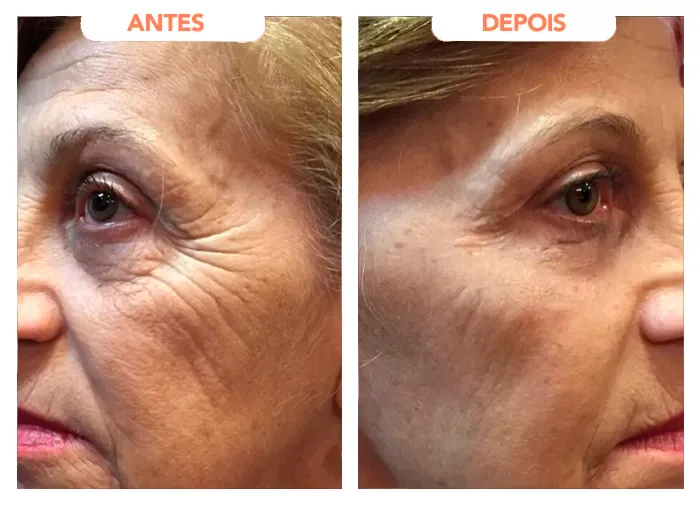 Antes e depois de clientes com o Trans Resveratrol.