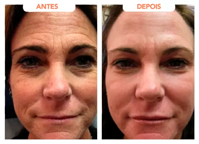 Antes e depois de clientes com o Trans Resveratrol.