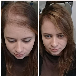 Fotos de clientes do Folixil. Resultado do tratamento. antes e depois.