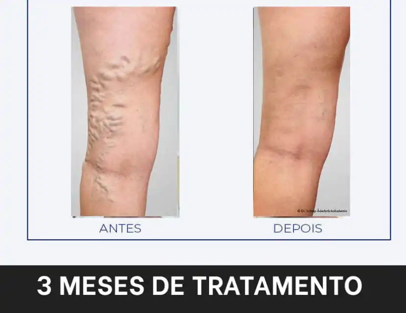 Antes e depois do uso do Varizemax.