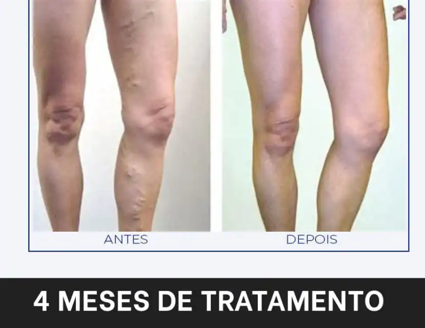 Antes e depois do uso do Varizemax.