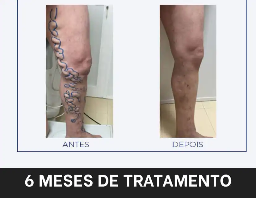 Antes e depois do uso do Varizemax.