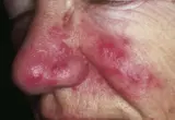 Imagem clínica ilustrativa de vermelhidão facial associada à rosácea