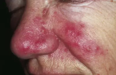 Imagem clínica ilustrativa de vermelhidão facial associada à rosácea