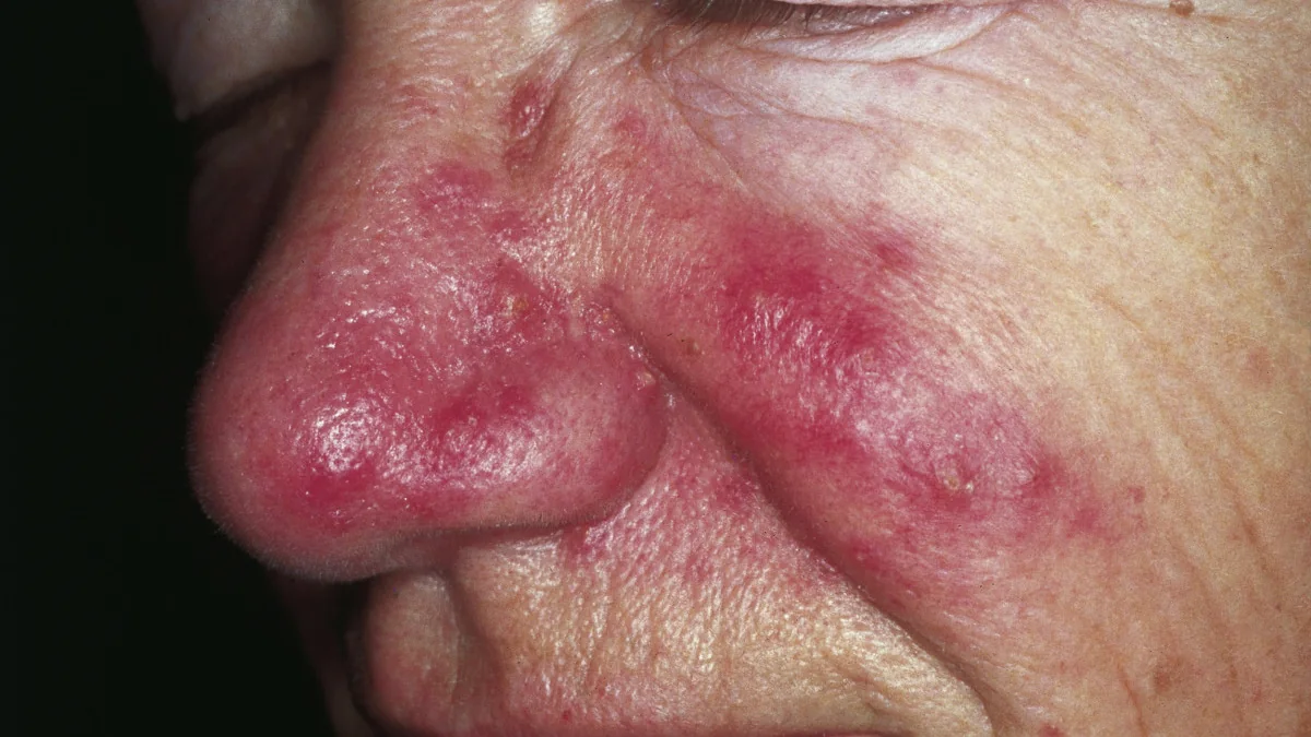 Imagem clínica ilustrativa de vermelhidão facial associada à rosácea