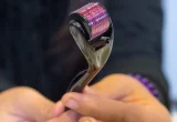 Microagulhamento com dermaroller em close, imagem de arquivo