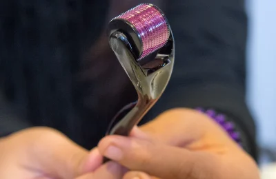 Microagulhamento com dermaroller em close, imagem de arquivo